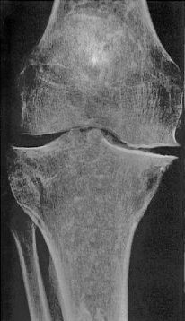 Röntgenbild eines nicht mehr ganz taufrischen Kniegelenkes