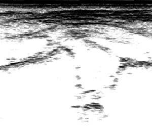 Sonografie einer Säuglingshüfte